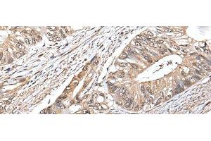 Immunohistochemistry of paraffin-embedded Human colorectal cancer tissue using ATF6B Polyclonal Antibody at dilution of 1:30(x200) (ATF6B anticorps)