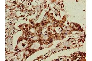 Immunohistochemistry of paraffin-embedded human pancreatic cancer using ABIN7151588 at dilution of 1:100 (ELP6 anticorps  (AA 95-195))