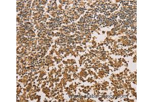 Immunohistochemistry of Human cervical cancer using SETD2 Polyclonal Antibody at dilution of 1:40 (SETD2 anticorps)