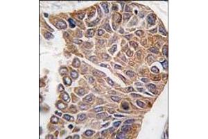 Formalin-fixed and paraffin-embedded human lung carcinoma tissue reacted with AKT2 antibody (C-term), which was peroxidase-conjugated to the secondary antibody, followed by DAB staining.