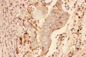 Anti-MMP7 Picoband antibody,  IHC(P): Human Intestinal Cancer Tissue (MMP7 anticorps  (AA 1-267))