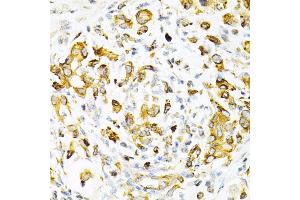 Immunohistochemistry of paraffin-embedded human gastric cancer using TAPBP Antibody (ABIN6132745, ABIN6148848, ABIN6148850 and ABIN6219122) at dilution of 1:200 (40x lens).