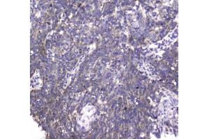 IHC testing of FFPE human lung cancer tissue with MRE11 antibody at 1ug/ml.