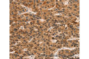 Immunohistochemistry of Human gastric cancer using KLRC1 Polyclonal Antibody at dilution of 1:30 (CD159a/c anticorps)