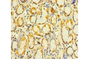 Immunohistochemistry of paraffin-embedded human gastric cancer using ABIN7175053 at dilution of 1:100 (KIAA1324-Like anticorps  (AA 227-526))