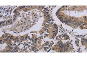 Immunohistochemistry of paraffin-embedded Human colon cancer tissue using CCL1 Polyclonal Antibody at dilution 1:50 (CCL1 anticorps)