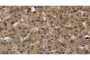 Immunohistochemistry of paraffin-embedded Human liver cancer using FABP2 Polyclonal Antibody at dilution of 1:40 (FABP2 anticorps)