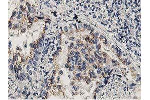 Immunohistochemical staining of paraffin-embedded Carcinoma of Human lung tissue using anti-LACTB2 mouse monoclonal antibody. (LACTB2 anticorps)