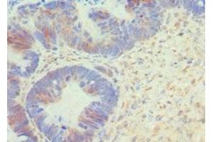 Immunohistochemistry of paraffin-embedded human ovarian cancer using ABIN7145167 at dilution of 1:100 (Cyclin D1 anticorps  (AA 1-233))