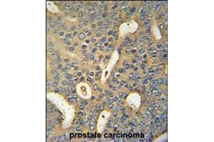 MICALL1 Antibody immunohistochemistry analysis in formalin fixed and paraffin embedded human prostate carcinoma followed by peroxidase conjugation of the secondary antibody and DAB staining. (MICAL-Like 1 anticorps  (C-Term))