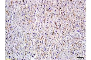 Formalin-fixed and paraffin embedded human hepatoma labeled with Anti-Hyaluronidase-PH20/Haase Polyclonal Antibody, Unconjugated (ABIN673779) followed by conjugation to the secondary antibody and DAB staining
