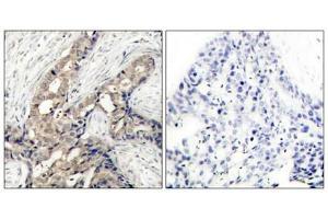 Immunohistochemical analysis of paraffin-embedded human breast carcinoma tissue using c-Abl (phospho-Tyr412) antibody. (ABL1 anticorps  (pTyr412))