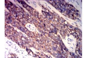 Immunohistochemical analysis of paraffin-embedded ewing sarcoma tissues using CD99 mouse mAb with DAB staining. (CD99 anticorps  (AA 1-185))