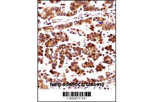 ORC3L Antibody immunohistochemistry analysis in formalin fixed and paraffin embedded human lung adenocarcinoma followed by peroxidase conjugation of the secondary antibody and DAB staining.