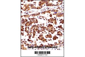 ORC3L Antibody immunohistochemistry analysis in formalin fixed and paraffin embedded human lung adenocarcinoma followed by peroxidase conjugation of the secondary antibody and DAB staining. (ORC3 anticorps  (N-Term))