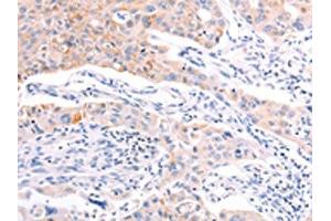 The image on the left is immunohistochemistry of paraffin-embedded Human lung cancer tissue using ABIN7192139(RalA Antibody) at dilution 1/20, on the right is treated with synthetic peptide.