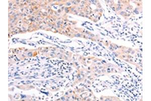 The image on the left is immunohistochemistry of paraffin-embedded Human lung cancer tissue using ABIN7192139(RalA Antibody) at dilution 1/20, on the right is treated with synthetic peptide. (rala anticorps)