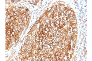 Formalin-fixed, paraffin-embedded human Lung Carcinoma stained with CD9 Mouse Monoclonal Antibody (CD9/1619).