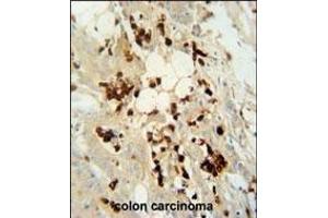 WDR21C antibody (N-term) (ABIN654576 and ABIN2844279) immunohistochemistry analysis in formalin fixed and paraffin embedded human colon carcinoma followed by peroxidase conjugation of the secondary antibody and DAB staining.