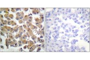 Immunohistochemistry analysis of paraffin-embedded human breast carcinoma tissue, using TGF beta1 Antibody. (TGFB1 anticorps  (AA 336-385))