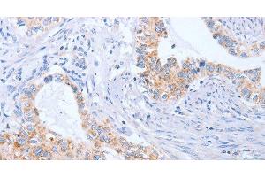 Immunohistochemistry of paraffin-embedded Human cervical cancer tissue using BST1 Polyclonal Antibody at dilution 1:50 (BST1 anticorps)