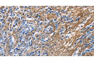 Immunohistochemistry of paraffin-embedded Human prostate cancer tissue using COL3A1 Polyclonal Antibody at dilution 1:60 (COL3A1 anticorps)