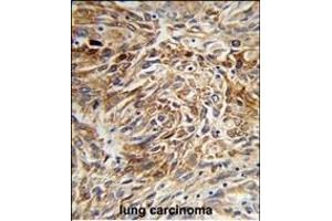 Formalin-fixed and paraffin-embedded human lung carcinoma reacted with AGR3 Antibody (C-term), which was peroxidase-conjugated to the secondary antibody, followed by DAB staining. (AGR3 anticorps  (C-Term))