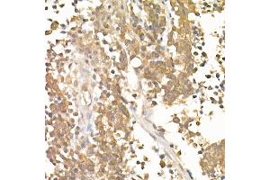 Immunohistochemistry of paraffin-embedded Human small cell lung cancer using β-Catenin antibody (ABIN7266138) at dilution of 1:100 (40x lens).
