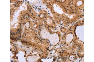 Immunohistochemistry of Human thyroid cancer using EPDR1 Polyclonal Antibody at dilution of 1:40 (EPDR1 anticorps)