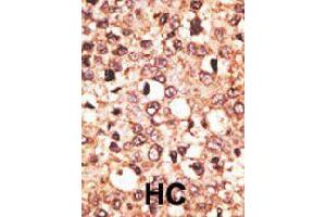 Formalin-fixed and paraffin-embedded human hepatocellular carcinoma tissue reacted with CRY1 polyclonal antibody  , which was peroxidase-conjugated to the secondary antibody, followed by AEC staining. (CRY1 anticorps  (C-Term))