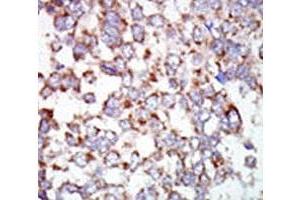 IHC analysis of FFPE human hepatocarcinoma tissue stained with the TAK1 antibody (TR4 anticorps  (AA 574-606))