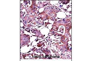 LGALS3 Antibody (C-term) ((ABIN657647 and ABIN2846642))immunohistochemistry analysis in formalin fixed and paraffin embedded human colon carcinoma followed by peroxidase conjugation of the secondary antibody and DAB staining. (Galectin 3 anticorps  (C-Term))