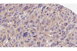 ABIN6272278 at 1/100 staining Human Melanoma tissue by IHC-P. (COL4a6 anticorps  (Internal Region))