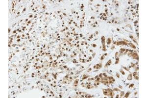 IHC-P Image Immunohistochemical analysis of paraffin-embedded A549 xenograft, using SOCS3, antibody at 1:100 dilution.