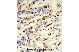 Formalin-fixed and paraffin-embedded human breast carcinoma reacted with IGHM Antibody (N-term), which was peroxidase-conjugated to the secondary antibody, followed by DAB staining. (IGHM anticorps  (N-Term))