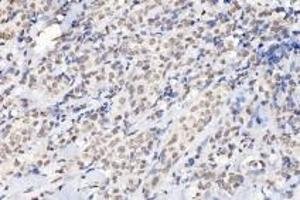 Immunohistochemistry analysis of paraffin-embedded human breast cancer using Ring1A (ABIN7075467) at dilution of 1: 3600