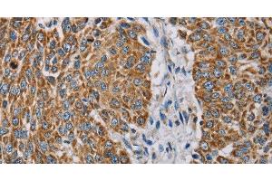 Immunohistochemistry of paraffin-embedded Human lung cancer using MTFP1 Polyclonal Antibody at dilution of 1:30