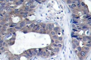 Immunohistochemistry (IHC) analyzes of IRS-1 antibdoy in paraffin-embedded human breast carcinoma tissue. (IRS1 anticorps)