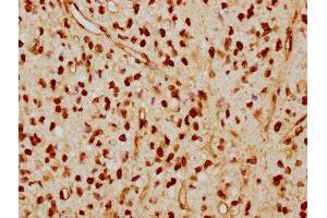 IHC image of ABIN7127601 diluted at 1:115 and staining in paraffin-embedded human glioma cancer performed on a Leica BondTM system. (Recombinant Lamin A/C anticorps)