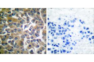 Peptide - +Immunohistochemical analysis of paraffin-embedded human breast carcinoma tissue, using FAP-1 antibody.