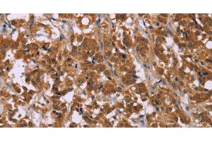 Immunohistochemistry of paraffin-embedded Human thyroid cancer using CMTM6 Polyclonal Antibody at dilution of 1:30 (CMTM6 anticorps)