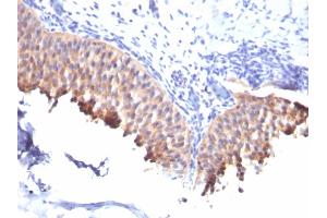 Formalin-fixed, paraffin-embedded human Bladder Carcinoma stained with Cytokeratin 10 Mouse Monoclonal Antibody (SPM261). (Keratin 10 anticorps)