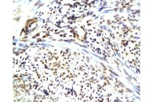 Formalin-fixed and paraffin embedded human endometrium carcinoma with Anti-CGRP/CGRP2 Polyclonal Antibody, Unconjugated (ABIN728218) at 1:200, followed by conjugation to the secondary antibody and DAB staining (CGRP anticorps  (AA 65-130))