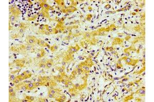 Immunohistochemistry of paraffin-embedded human liver cancer using ABIN7170696 at dilution of 1:100 (SND1 anticorps  (AA 560-732))
