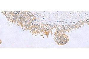 Immunohistochemistry of paraffin-embedded Human prost ate cancer tissue using GPCPD1 Polyclonal Antibody at dilution of 1:55(x200) (GPCPD1 anticorps)