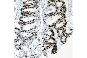 Immunohistochemical analysis of HNF4 alpha (pS313) staining in human colon cancer formalin fixed paraffin embedded tissue section. (HNF4A anticorps  (pSer313))