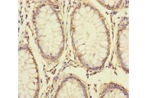 Immunohistochemistry of paraffin-embedded human colon cancer using ABIN7166047 at dilution of 1:100 (S100A14 anticorps  (AA 1-104))
