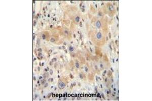 NR0B2 antibody (Center) (ABIN655027 and ABIN2844658) immunohistochemistry analysis in formalin fixed and paraffin embedded human hepatocarcinoma followed by peroxidase conjugation of the secondary antibody and DAB staining.