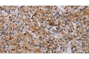 Immunohistochemistry of paraffin-embedded Human prostate cancer tissue using AATK Polyclonal Antibody at dilution 1:45 (AATK anticorps)