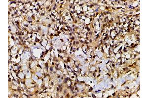 ABIN6277691 at 1/200 staining human meningeal carcinomatosis(MC) tissue sections by IHC-P. (Ephrin B2 anticorps  (C-Term))